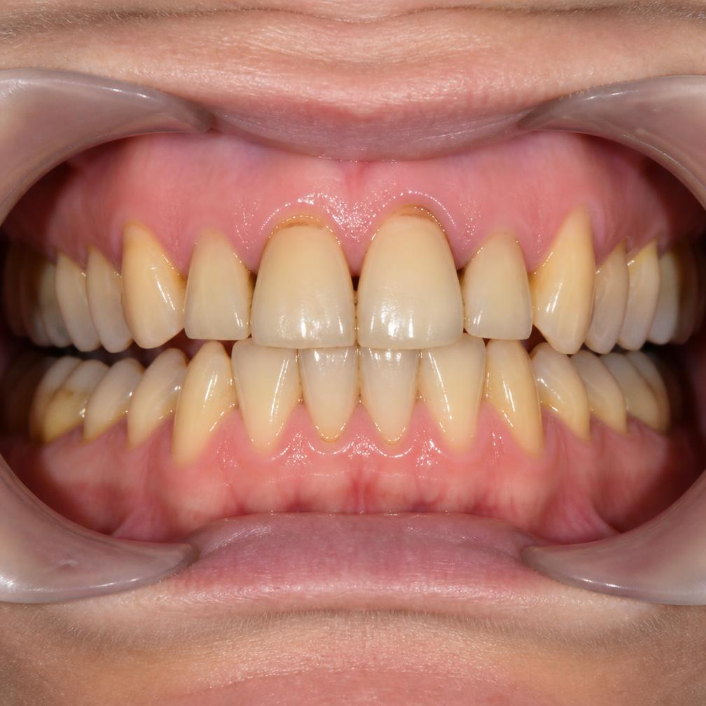 Estado inicial antes del tratamiento: dientes desgastados y pigmentados